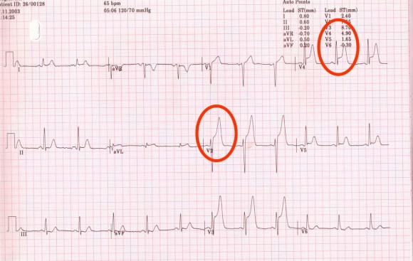 http://doktori.mk/files/upload/1353/ECG-STEMI.jpg